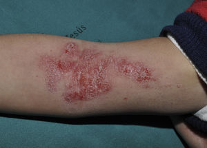 Irritation caused by the application of topical imiquimod on the right forearm.