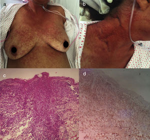 Acute ATLL. (a) 64yo female with multiple papules distributed on trunk and proximal extremities for over three months. (b) Papules are asymptomatic, erythematous, with increased consistency. (c) Infiltration of dermis by atypical lymphoid cells with epidermotropism. Hematoxylin and Eosin stain, x20. (d) Immunohistochemistry CD3+, x20. The patient died after 2 weeks of admission from septic shock.