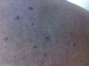 Brown-grey oval macules, slightly palpable, well delimitated, 2-to-5mm in diameter, many with collarettes of scale.