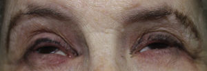 Due to the presence of congenital ankyloblepharon, the patient had undergone numerous eye procedures. At the time of consultation she presented severe photosensitivity. Patchy alopecia affecting eyebrows and eyelids can also be seen in this photo.
