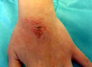 Eczema on the dorsum of the nondominant hand of a patient who reported using this area to wipe off the finger of the dominant hand, which she used to remove excess polish around the edges of the nails.