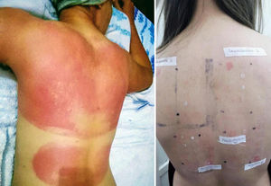 Patient with photosensitive reaction after exposure to sunlight with pediatric sunscreen. Patient with a history of intolerance to cosmetics. After the test, the patient had a photosensitivity reaction to benzophenone-10 and reaction in the irradiated area and nonirradiated area to benzophenone-3, both of which are components of the sunscreen.