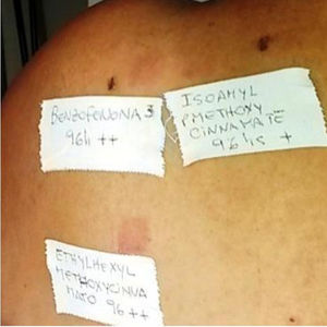 Reactions in the irradiated area to oxybenzone and to 2 cinnamates, thus confirming PACD to organic sunscreens. These were replaced by physical sunscreens.