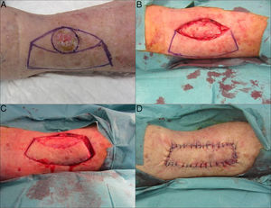 Design and technique of the keystone flap. A, The flap design is marked. B, The lesion is excised. C, Dissection is performed without reaching the deep fascia. D, The defect is closed.