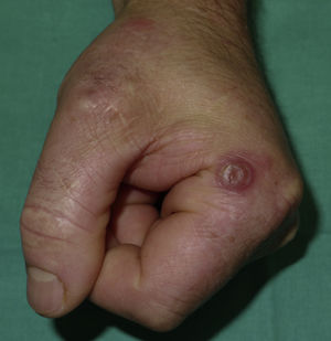 Solitary nodule surrounded by an erythematous halo at the lateral base of the left index finger.