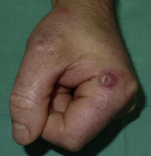 Solitary nodule surrounded by an erythematous halo at the lateral base of the left index finger.