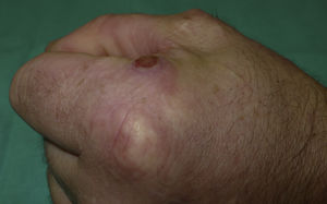 Lateral photograph of the nodule showing the mechanism of infection.