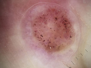 Dermoscopic image showing the numerous hemorrhagic dots against a homogeneous pink area.