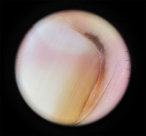 Dermoscopy findings: regular, parallel bands, brown pigmentation of proximal and lateral nail folds (Hutchinson sign).