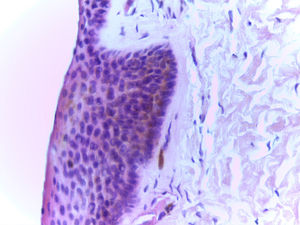 Acanthotic squamous epithelium with adequate cell maturation, epithelial melanosis in the basal layer, and isolated melanophages in the stroma. Note the absence of melanocytic proliferation (hematoxylin-eosin, original magnification ×400).