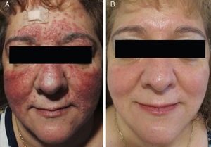 A, Increase in number of papules and pustules during conventional treatment. B, Appearance 8 weeks after finishing treatment with oral azithromycin.