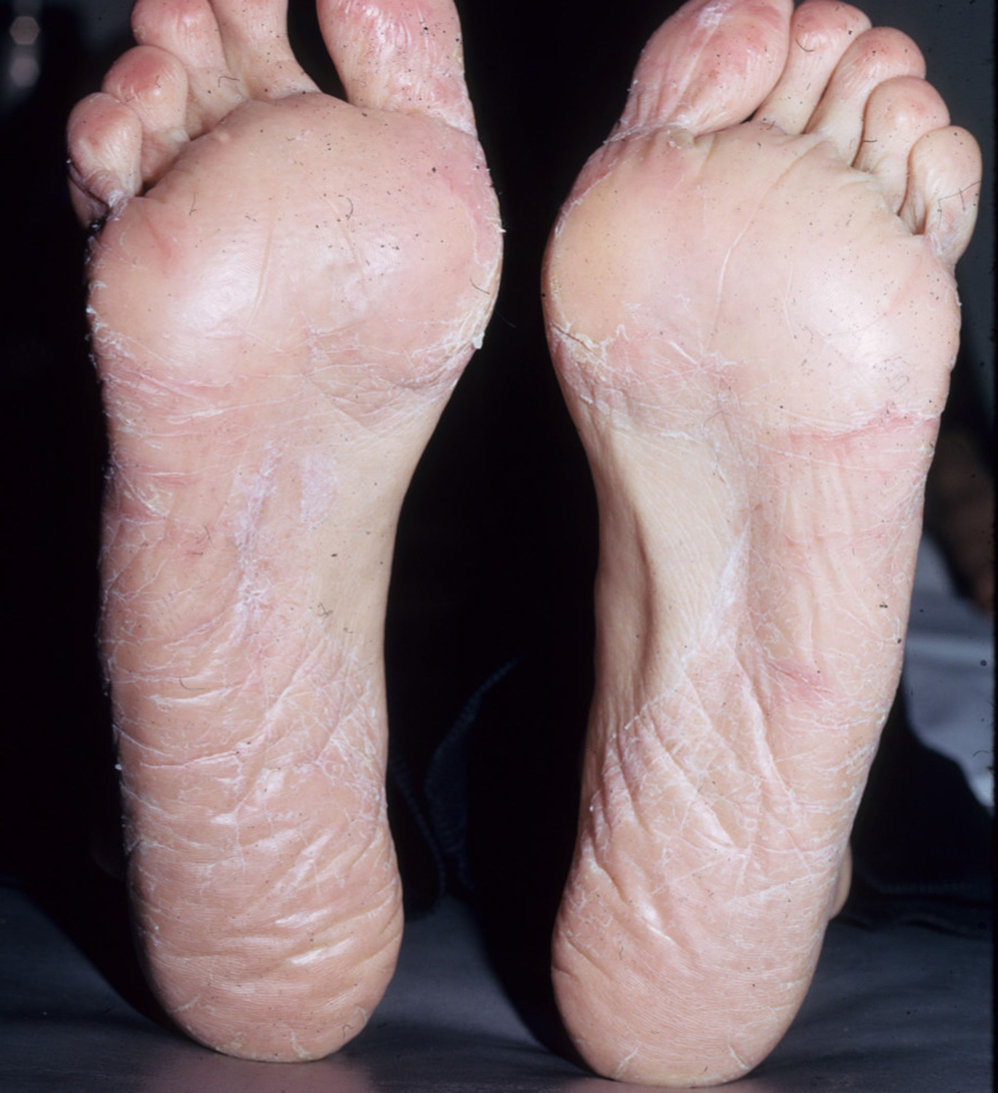 PDF] Allergic Contact Dermatitis of the Foot after use of Mastisol