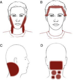 Clinical patterns of allergic contact dermatitis affecting the scalp. A, Rinse-off pattern: eczematous plaques on the sides of the face (preauricular and mandibular) and neck; B, C, and D, pattern along the hairline. B, Forehead and area above the ears. C, Occipital and retroauricular area.