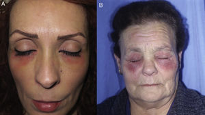 Allergic contact dermatitis caused by eye drops. A, Eczematous plaques mainly affecting the lower eyelids and cheeks. B, The upper eyelids may also be involved.