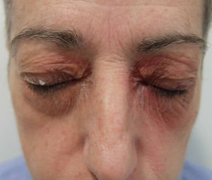 Contact dermatitis caused by eye shadow (contour pattern).