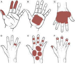 Clinical patterns of allergic contact dermatitis affecting the hands. A, Pincer grip pattern. B, Palmar grasp pattern. C, Apron pattern. D, Ring pattern. E, Glove pattern. F, Periungual pattern.