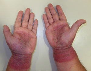 Palmar grasp pattern. Note the involvement of the wrists indicating allergic contact dermatitis.