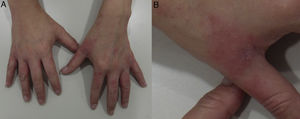 Irritant contact dermatitis with an apron pattern. A, Eczematous plaques affecting the interdigital spaces and dorsum of the hands. B, Detail of interdigital involvement.