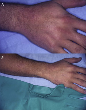 Allergic contact dermatitis with a glove pattern. A and B. Eczematous plaques arranged in patches affecting the dorsum of the right hand and forearm in a patient with allergic contact dermatitis caused by thiuram in rubber gloves.