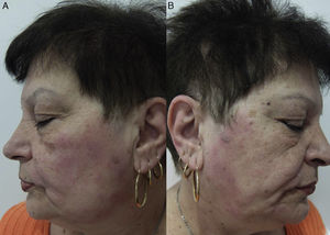 A and B. Allergic contact dermatitis caused by shampoo affecting both sides of the face (rinse-off pattern).