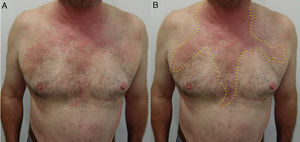 Allergic contact dermatitis in a drip pattern. Patient with allergic contact dermatitis to Kathon CG in soap used daily. A, Eczematous plaques following the flow of the product along the anterior thorax. B, Detail of the morphology of the lesions.