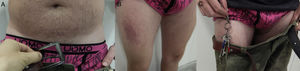Allergic contact dermatitis to nickel. A, Eczematous plaque below the umbilicus caused by nickel in a belt buckle. B, Eczematous plaque on the right thigh. C, Detail of the association between metallic keys and the eczematous plaque.
