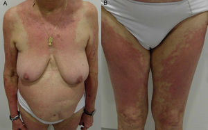 Textile pattern allergic contact dermatitis. A, Eczematous plaques on the internal surface of the arms and the forearms. Involvement of the intermammary area sparing the area covered by the patient's bra (cups and straps). B, Involvement of both thighs.