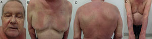 Allergic contact dermatitis with a generalized patchy pattern. A, Patchy eczematous plaques on the forehead, cheeks, and chin. B, Patchy eczematous plaques on the anterior trunk. C, Patchy eczematous plaques on the back. D, Patchy eczematous plaques on both forearms.