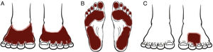 Clinical patterns of allergic contact dermatitis of the feet. A, Shoe pattern. B, Sole pattern. C, Localized pattern.