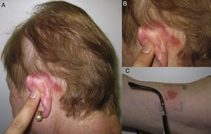 A and B, Allergic contact dermatitis caused by the earpiece of the patient