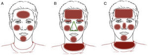 Clinical patterns of allergic contact dermatitis affecting the face. A, Bilateral patchy pattern. B, Airborne pattern. C, Photoallergic pattern.