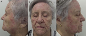 A, B, and C. Observe the presence of eczematous plaques arranged in patches.