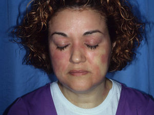 Airborne allergic contact dermatitis. Note the involvement of the eyelids, nasolabial folds, and, to a lesser extent, the neck. The tip of the nose is not involved (beak sign).