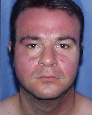 Photoallergic contact dermatitis. In contrast with the airborne pattern (Fig. 7), the eyelids are not affected, whereas the tip and bridge of the nose are.