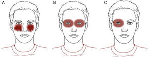 Clinical patterns of allergic contact dermatitis affecting the eyelids. A, Drip pattern; B, Contour pattern. C, Unilateral pattern.