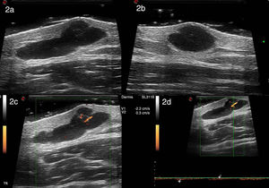 High-resolution ultrasound with a 22-MHz probe (MyLab class C, Esaote) reveals a well-defined polylobulated anechoic image with an internal septum located in the dermis and hypodermis. Positive enhancement was observed. The image measured 11.9mm along its transverse axis (A) and 5.9mm along its longitudinal axis (B). Power Doppler revealed sparse intralesional vascularization with arterial and venous vessels measuring between 0.2 and 0.4mm in diameter (C). Spectral Doppler showed that the arterial vessels had a maximum systolic peak of 2.2cm/s (D).