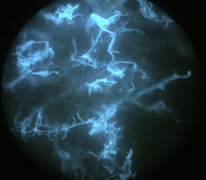 Calcofluor-white staining reveals numerous fungal structures consisting of broad, branched, aseptate hyphae compatible with mucormycosis.