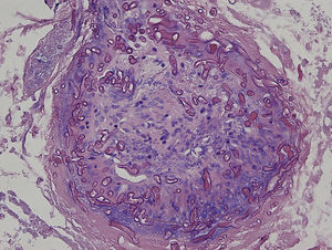 Histology reveals multiple fungal structures affecting the blood vessels, compatible with mucormycosis.