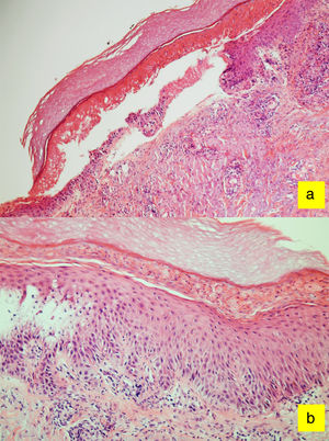 Results of histologic examination in Case 1: A, epidermal detachment (hematoxylin-eosin ×40); B, Spongiosis, vacuolar degeneration of the basal layer, and neutrophil exocytosis (hematoxylin-eosin ×70).