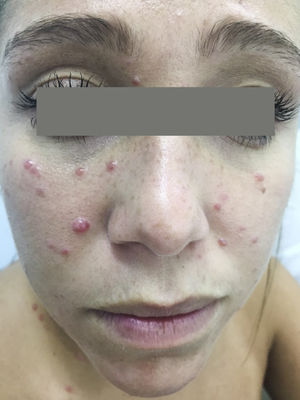 Diffuse scattered non-follicular based flesh-colored papules and small nodules, some with central indentations, were seen on the face and the trunk.