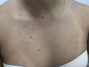 Diffuse scattered non-follicular based flesh-colored papules and small nodules, some with central indentations, were seen on the face and the trunk.