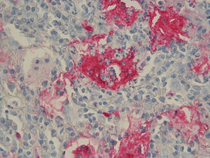 Histopathological features. Dense nodular dermal mononuclear cell rich infiltrate showing a significant number of plasma cells and numerous scattered S100 positive multinucleated histiocytes with marked emperipolesis and inconspicuous eosinophils.