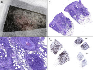 a) The 3-cm-diameter erythematous plaque on the scalp. b) Haematoxylin and eosin staining showed mild vacuolar change in epidermal basal cells as well as perifollicular lymphohistiocytic infiltration and caryorrhexis in the reticular dermis (40x). c) The perifollicular lymphohistiocytic infiltration in haematoxylin and eosin staining (200x). d) Immunochemical analysis revealed that the lymphoid infiltrate was predominantly CD3+, with CD8 positive cells predominating over CD4.