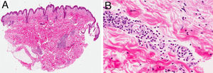 A, Hematoxylin-eosin, original magnification ×10; B, Hematoxylin-eosin, original magnification ×40.