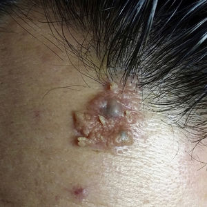 Yellowish plaque on the forehead containing areas with an irregular texture and blue nodules.