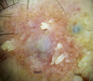 Two large asymmetric blue-gray ovoid nests, one containing thick vessels and a symmetric erythematous lesion with exophytic papillary structures and dotted and linear vessels in the interior.