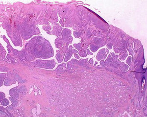 Trichoblastoma and syringocystoadenoma papilliferum in a sebecaeous nevus (numerous structures similar to follicle germinal cells with cystic invaginations composed of 2 layers of epithelial cells (hematoxylin and eosin, original magnification ×10).