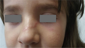 Erythematous, serpiginous trail caused by cutaneous larva migrans involving the nasal dorsum and left paranasal region.