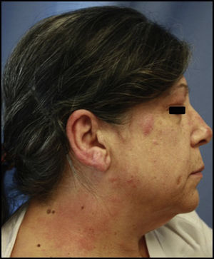 Acute eczema after application of hair dye. The areas affected include the upper eyelid, ear, and neck.