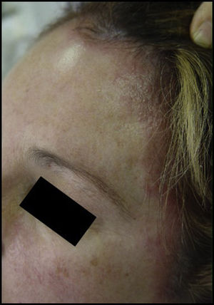 Acute eczema on the forehead and hairline after application of hair dye.